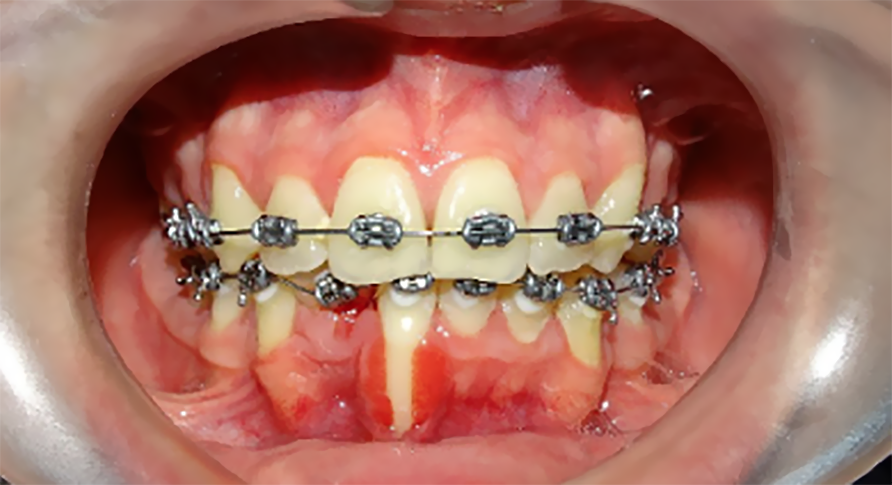 Céntrico enemigo visitante Consecuencias de una ortodoncia mal realizada - Dental Concept